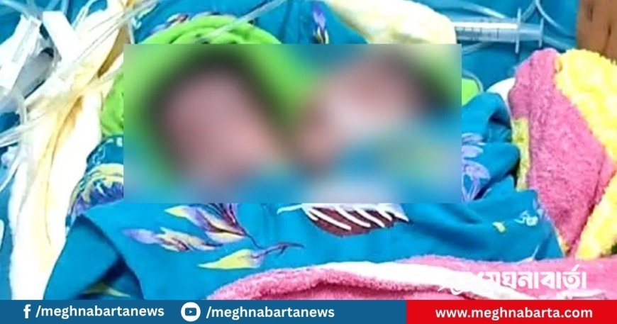দুটি মাথা নিয়ে এক শিশুর জন্ম