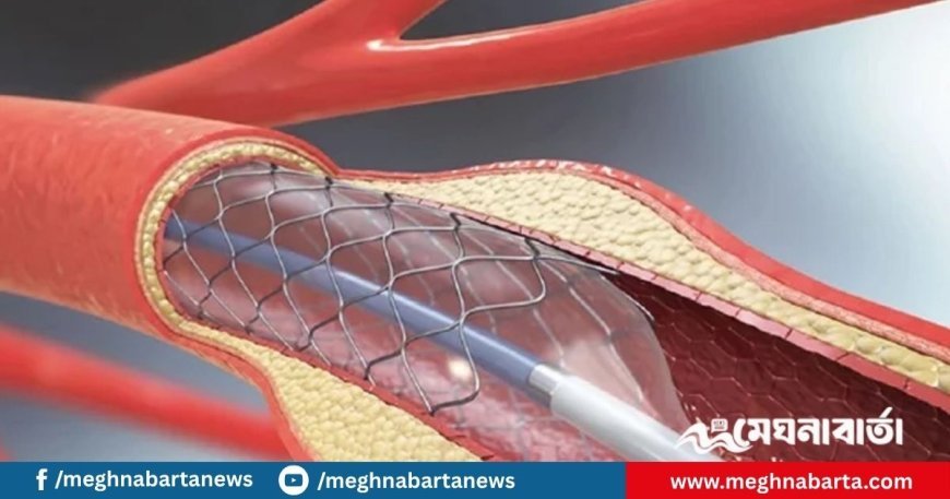দাম কমলো হার্টের রিংয়ের
