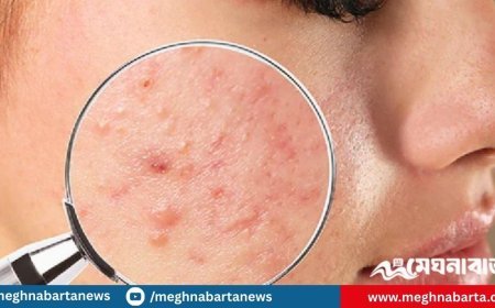 মুখভর্তি ব্রণ দূর করতে চান? ডায়েট থেকে বাদ দিতে হবে যেসব খাবার