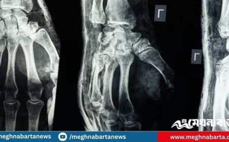 তিন মিনিটে ভাঙা হাড় জোড়া লাগানোর প্রযুক্তি উদ্ভাবনের দাবি চীনা চিকিৎসকদের