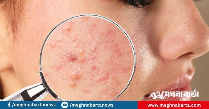 মুখভর্তি ব্রণ দূর করতে চান? ডায়েট থেকে বাদ দিতে হবে যেসব খাবার